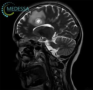 МРТ головного мозку
