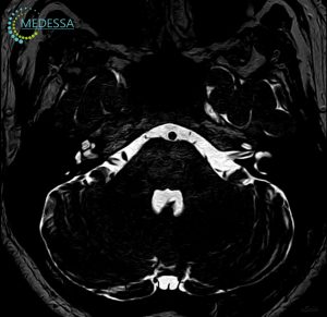 МРТ мостомозочкового кута (ММУ)