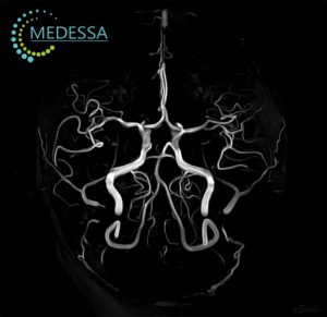 МР-ангіографія артерій головного мозку (артеріографія)