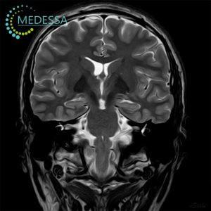 МРТ головного мозку при епілепсії