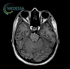 МРТ орбіт та зорових нервів