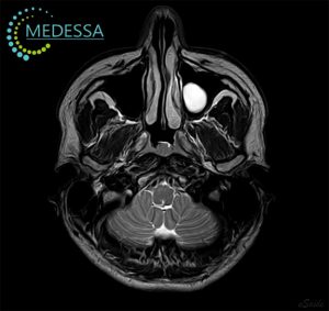 МРТ придаткових пазух носа