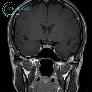 МРТ гіпофіза та турецького сідла