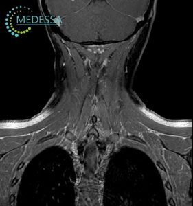 МРТ м'яких тканин шиї