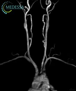 МР-ангіографія судин шиї