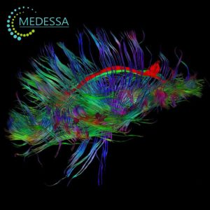 МРТ-трактографія (дифузійно-тензорна трактографія — DTI)