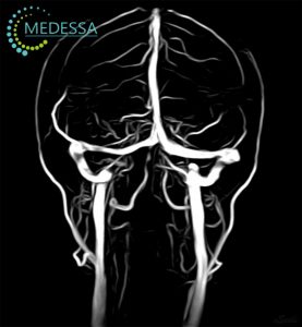 МР-ангіографія вен головного мозку (венографія)