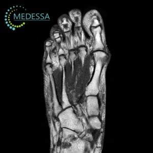 МРТ дистального відділу стопи Одеса