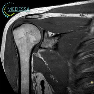 МРТ плечового суглоба Одеса