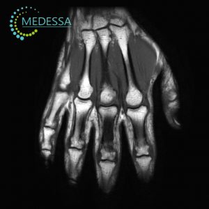 МРТ дистального відділу кисті Одеса