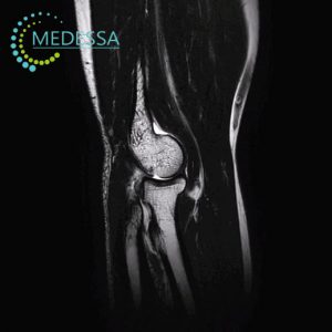МРТ ліктьового суглоба Одеса