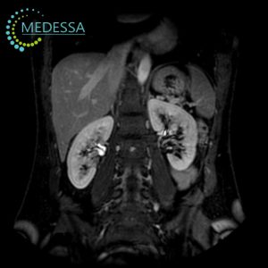 MRI of the Retroperitoneal Organs