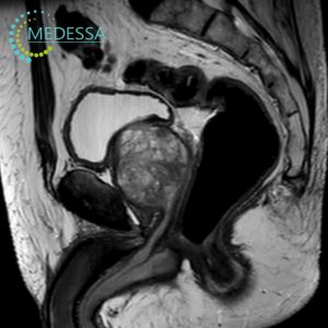 MRI of the Male Pelvic Organs