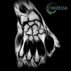 МРТ променево-зап’ясткового суглоба та проксимального відділу кисті Одеса