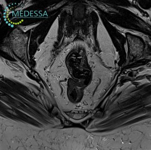 МРТ прямой кишки ануса