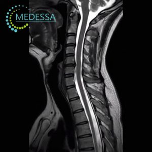 MRI of the Cervical Spine