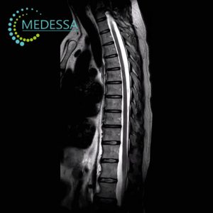 MRI of the Thoracic Spine
