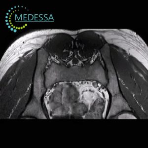 MRI of the Sacroiliac Joints
