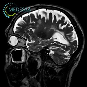 multiple_sclerosis