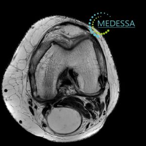 киста бейкера МРТ колена Одесса
