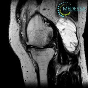мрт коленного сустава Одесса